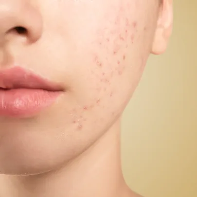 TERAPIA TRĄDZIKOWA W KASHMIR SPA