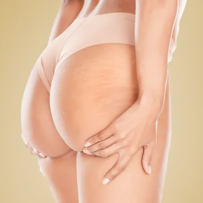 Cennik zabiegów według problemu w Kashmir Spa - Blizny i rozstępy - zdjęcie przedstawia pośladki kobiety z roztępami