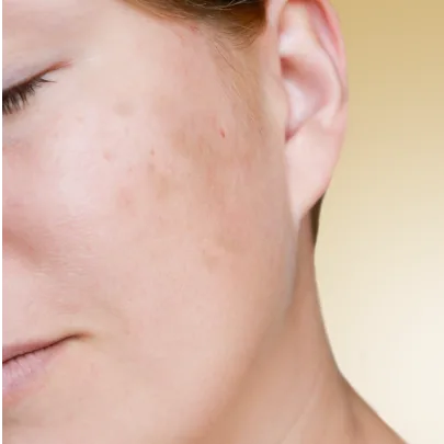 Cennik zabiegów według problemu w Kashmir Spa - przebarwienia na twarzy