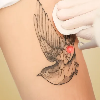 Cennik zabiegów według problemu w Kashmir Spa - LASEROWE USUWANIE TATUAŻU I MAKIJAŻU PERMANENTNEGO W KASHMIR SPA GDAŃSK