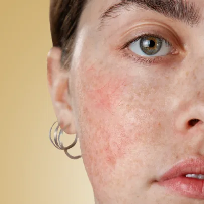 Cennik zabiegów według problemu w Kashmir Spa - naczynka i rumień