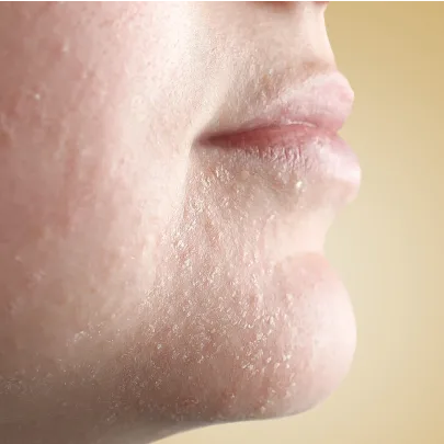 Cennik zabiegów według problemu w Kashmir Spa - Sucha skóra - zdjęcie przedstawia wyszuszoną skórę twarzy