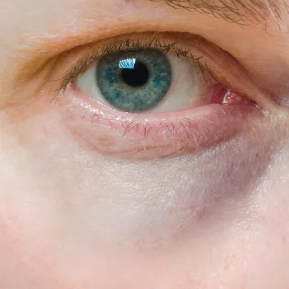 Cienie pod oczami - zdjęcie przedstawia oko z widocznymi sińcami.