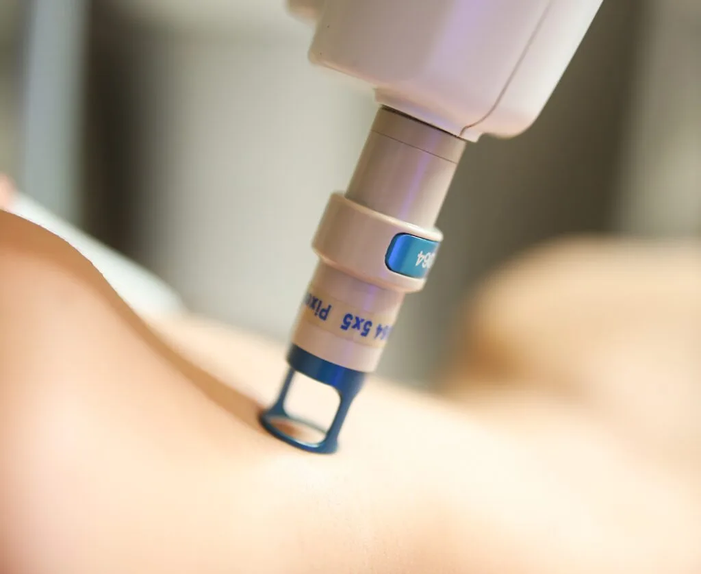 Laser Frakcyjny Nieablacyjny podczas zabiegu w Kashmir Spa Gdańsk