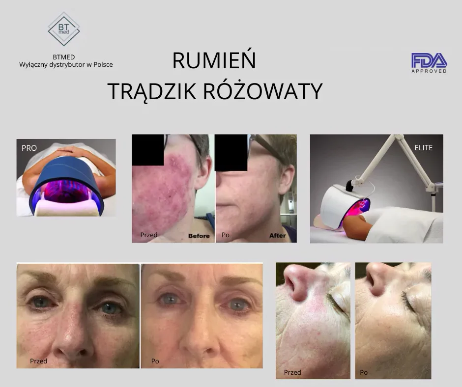 Terapia Led lampą Celluma