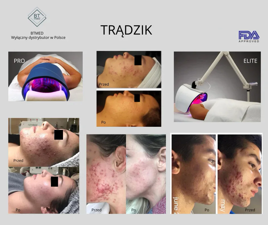 Terapia Led lampą Celluma