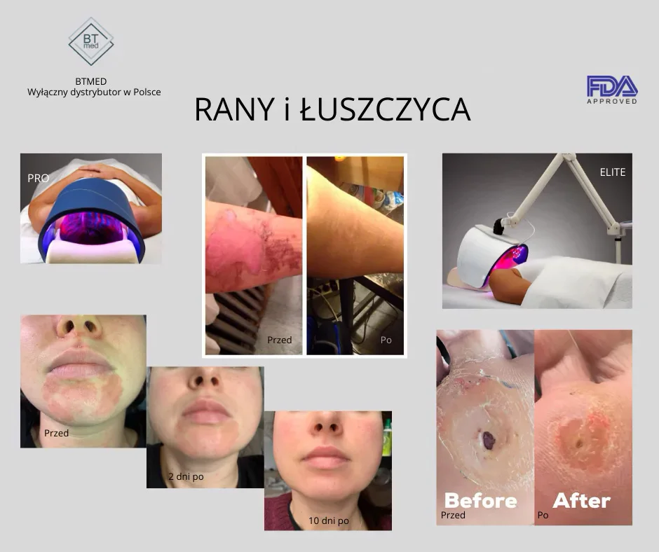 Terapia Led Lampą Celluma